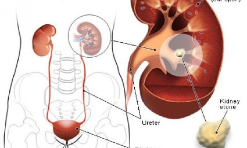 How to remove kidney stones and stones in the organs of digestive system without medication!