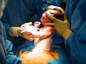 cesarean2