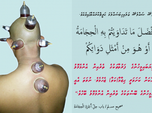 Hijama j