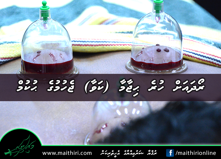 ރޯދައަށް ހުރެ ޙިޖާމާ (ކަވާ) ޖެހުމުގެ ޙުކުމް