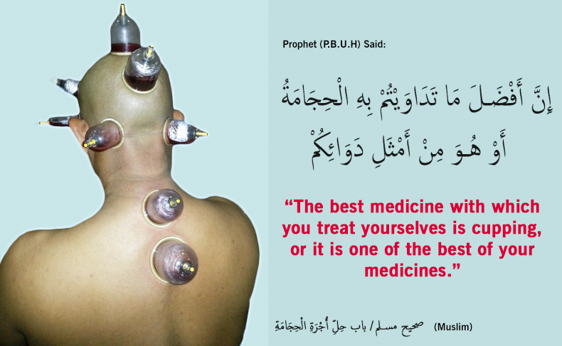 Cupping (Hijama) – From the prophetic medications 1